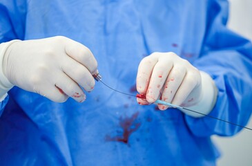 Surgeons in blue surgical attire conduct a transarterial chemoembolization procedure, skillfully maneuvering tools amidst a sterile environment to treat patients effectively