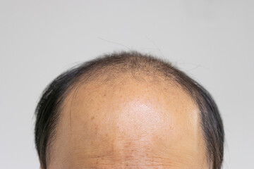 薄毛の男性の頭（日本人、30代）