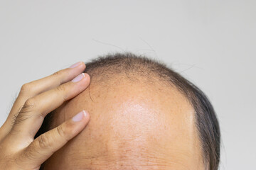 薄毛の男性の頭と手（日本人、30代）