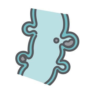 大腸憩室の断面図と便の詰まり（糞石）