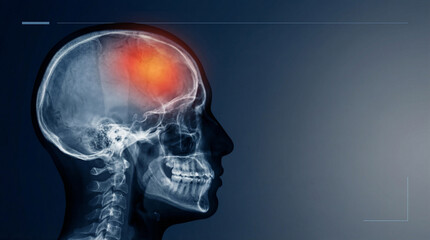 Brain X-ray, illustrating a human skull with a glowing area indicating pain, a medical concept for neurological diagnosis, headache, and health.
