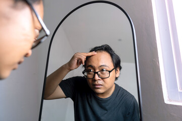 A bald man looks in the mirror, hair loss treatment, Concept of baldness treatment or hair restoration