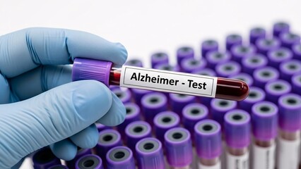 Laboratory technician holding Alzheimer's test tube with blood sample for diagnostic analysis in a clinical lab setting with many test tubes in the background