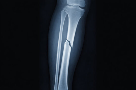 X-ray image of lower leg bone fracture isolated on black background