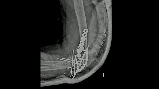 Post-operative X-ray of Left Elbow Fracture Repair