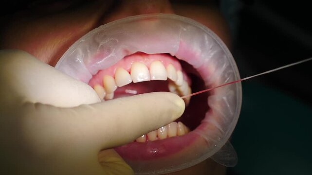 Oral hygiene. Ultrasonic teeth cleaning machine removing calculus and plaque. human teeth treatment. Professional dentist treating patient in modern dental clinic. dental care and hygiene