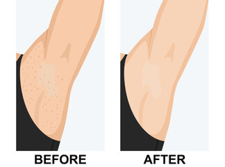 Before and after effective underarm skin care. Before depicts irritation, red bumps, and ingrown hair, After shows smooth, clean, and clear skin
