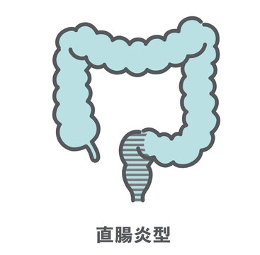 潰瘍性大腸炎・直腸炎型のイラスト（病変範囲）