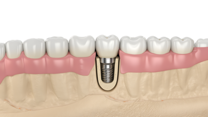 Anatomy of a dental implant a visual guide to tooth replacement in the jawbone structure