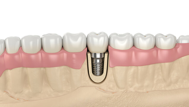 Anatomy of a dental implant a visual guide to tooth replacement in the jawbone structure
