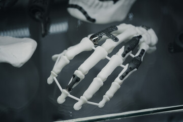 3D printed prosthetic hand model with titanium implants, metal plates, screws integrated into skeletal structure for orthopedic medical reconstruction Skeleton with black titanium fixation plates 