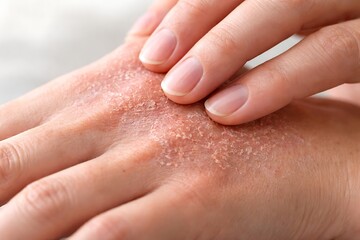 Close up view of a person scratching a dry red hand suffering from eczema or dermatitis