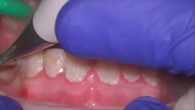 tooth tartar and calculus cleaning