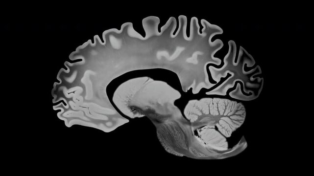 Alzheimer Atrophy on Brain in Sagittal View on Transparent Background