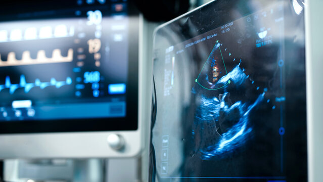 Medical ultrasound equipment displaying real-time imaging of a patients heart in a modern operating room, showcasing advanced technology and surgical precision in healthcare