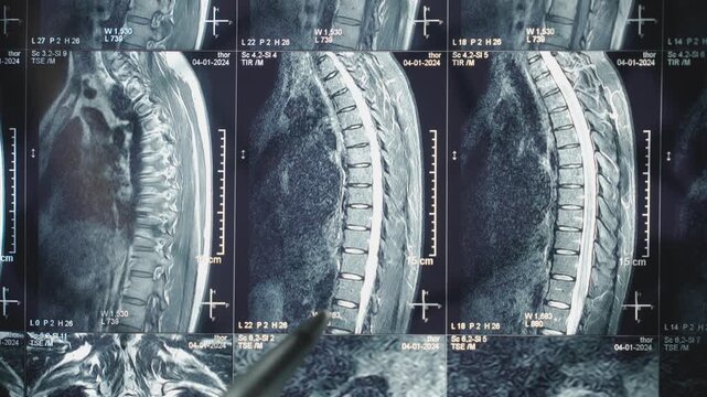 Doctor Pointing Pen at Spine MRI Scan on Monitor | Medical Analysis of Vertebrae and Spinal Cord | Healthcare Professional Examining Back Pain Diagnostic Images