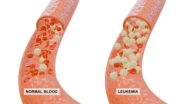 Animation of leukemia in 3D. Comparison of normal blood and blood from a leukemia patient. Suitable for presentations and children's learning.