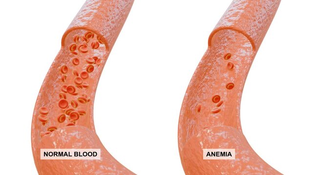 Animation of anemia in 3d. Comparison of normal and anemic blood. Suitable for presentations and children's learning.