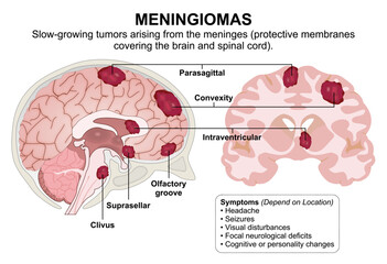 Menigiomas infographic flashcard brain tumor