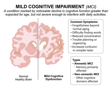 Mild Cognitive Impairment (MCI) Brain Flashcard
