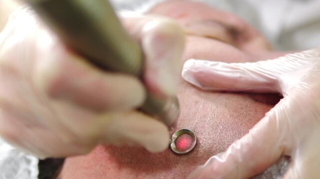 Male patient getting laser complexion cleaning in modern spa center, facial skin care and treatment. Laser beauty clinic. Skin polishing using laser technologies. Modern innovative medical equipment