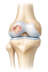 Medical Illustration of Knee Joint with Cartilage Damage, osteochondral lesion