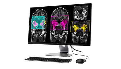 Modern radiology workstation showing pelvic MRI scans with transparent AI annotation boxes highlighting abnormal tissue areas displayed on a sleek monitor.