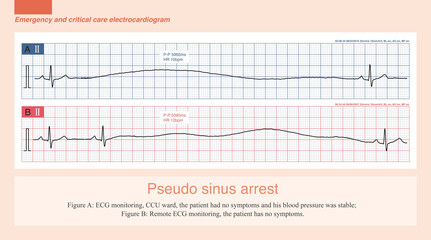 Sometimes, electrode detachment can cause a sudden disappearance of the ECG waveform, which should not be misdiagnosed as sinus arrest. Typically, baseline drift on the ECG is more pronounced.  © 凌鲲 宋