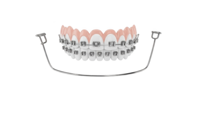 Dental braces on white teeth with pink gums and metal wire arch on black background image