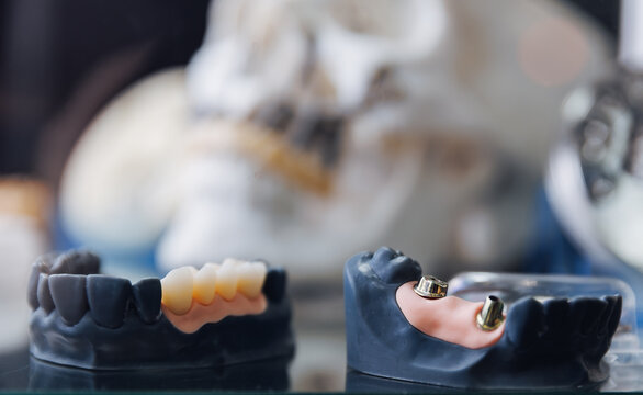 Exhibition examples of dental prostheses, titanium crowns and platforms for pins