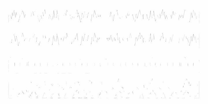 An electrocardiogram display showing complex heart rhythm patterns on a white background