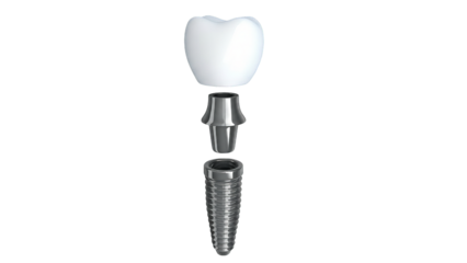 Dental implant components elegantly showcased with a floating arrangement on dark surface