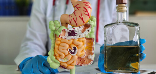 Doctor with model of intestine anatomy with stomach and alcohol. Pancreatic cancer, acute and chronic pancreatitis