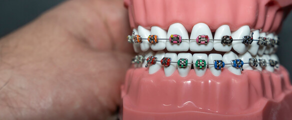 A close-up view of a dental model featuring colorful braces on white teeth held by a hand, illustrating orthodontic care and dental education in a clinical setting.