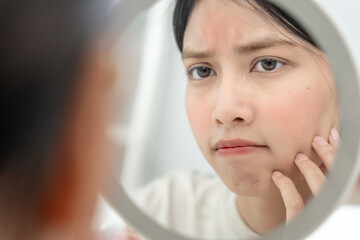 Young woman are worried about faces Dermatology and allergic to steroids in cosmetics. sensitive skin, red face from sunburn, acne, allergic to chemicals, rash on face. skin problems and beauty