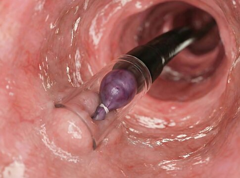 3D Medical Illustration of Endoscopic Variceal Ligation (EVL). Close-up view inside the esophagus showing a suctioned varix vein trapped in a ligation cap with a rubber band applied. 