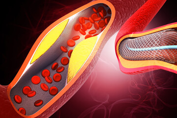 Medical illustration depicting the process of a balloon angioplasty and stent placement to treat a narrowed or blocked coronary artery caused by cholesterol plaque buildup. 3d illustration
