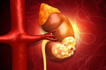 Conceptual image of kidney cancer progression, showing cellular transformation and tumor growth within the renal anatomy. 3d illustration