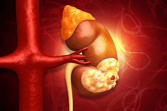 Conceptual image of kidney cancer progression, showing cellular transformation and tumor growth within the renal anatomy. 3d illustration