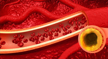 Clogged Coronary Artery. A detailed 3D medical illustration showing cholesterol plaque buildup (atherosclerosis) causing stenosis and restricted blood flow to the heart.