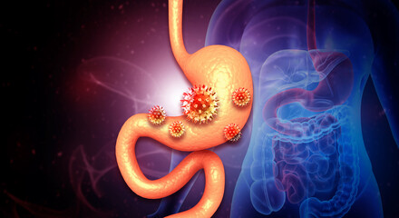 3D Illustration of Human Stomach with Virus Cells. Conceptual image of stomach infection, viral gastroenteritis, or digestive system disease.