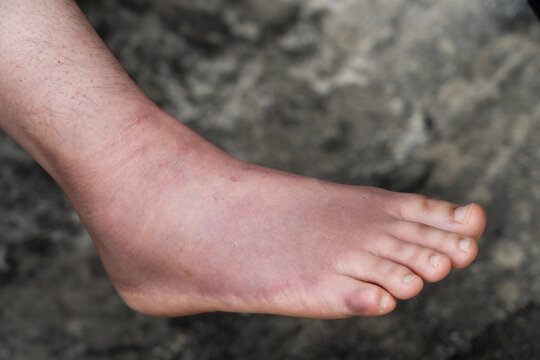 Swollen Foot After Cast Removal of Metatarsal Fracture