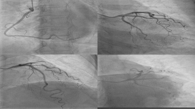 Coronary Angiogram showing Left and Right arteries  