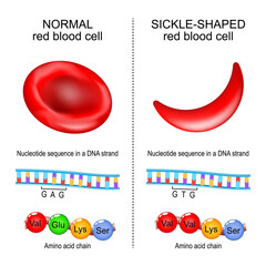 Sickle cell disease. Anemia. Red blood cell
