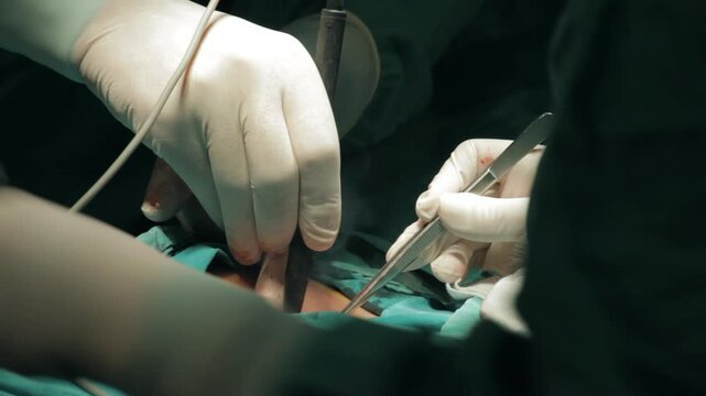 Surgeon using electrocautery tool to stop bleeding during surgery, close-up