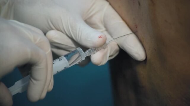 Anesthesiologist administering spinal anesthesia injection into patient's back, close-up