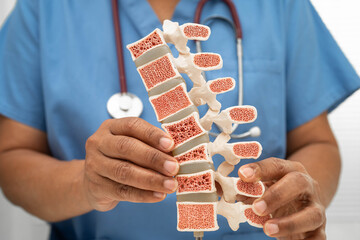 Doctor holding osteoporosis in back bone model for treatment medical in orthopedic department.