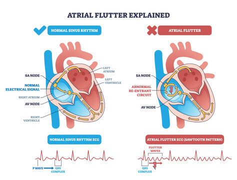 Atrial flutter explained diagram contrasts normal rhythm with re-entrant circuit in the heart, highlighting SA node, AV node, and sawtooth ECG pattern for clarity. Outline diagram