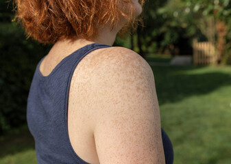 Freckled upper arm and shoulder of fair-skinned red-haired woman standing outdoors