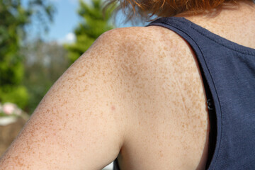 Close-up of freckles on shoulder and upper back of fair-skinned red-haired woman